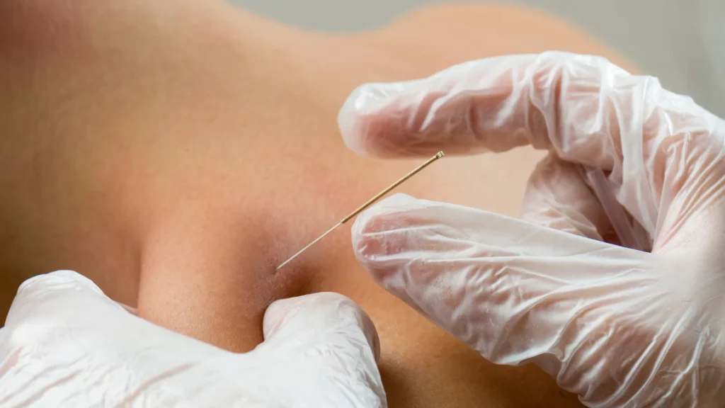 Choosing the Right Acupuncture Method